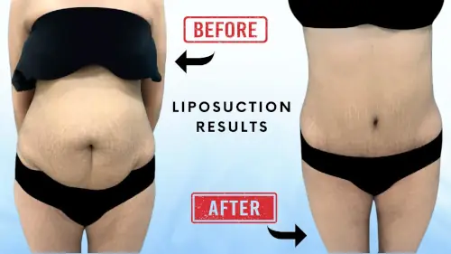 Liposuction before after results Liposuction before after results